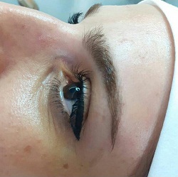 میکروبلیدینگ